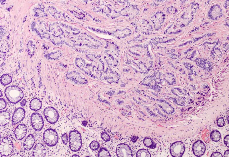 Tumour Microenvironment